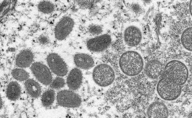 Que sait-on de la variole du singe dont de premiers cas ont été détectés en Europe